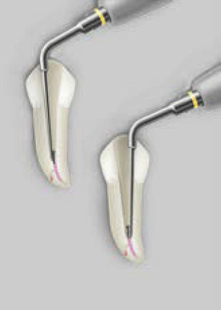 Acteon ET25 – Насадка «средняя» из Ti-Nb